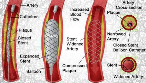 angioplasty