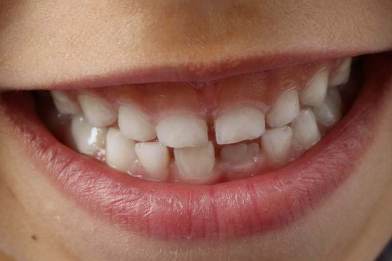 teeth-child smile