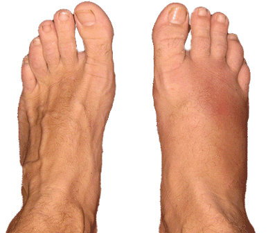 Foot Fracture
