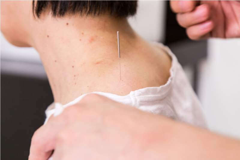 Acupuncturist needle pricking into skin