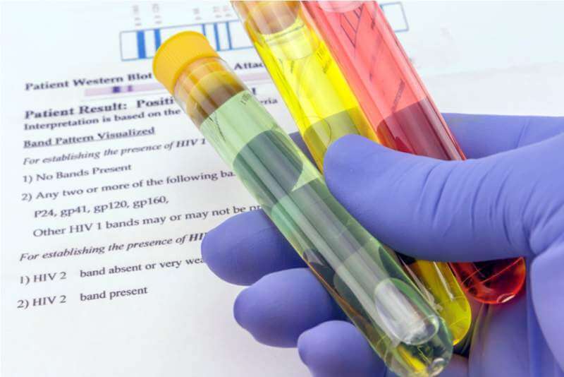 blood-sample-and-lab-request-for-anti-hiv-testing