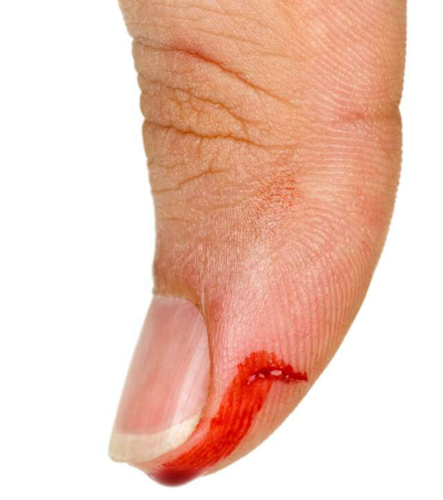 Bleeding thumb finger