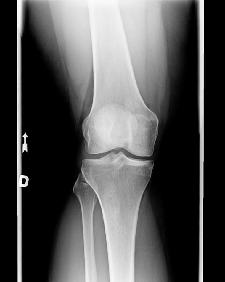 x-ray-of-knee-with-chondromalacia-condition