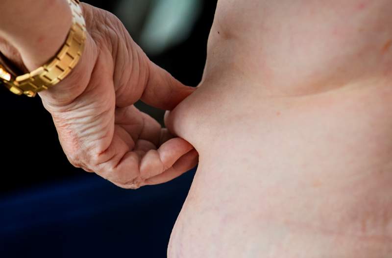 closeup-of-obese-elderly-woman