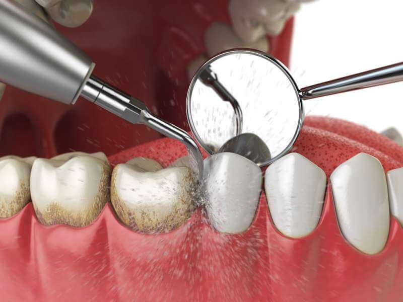 professional-teeth-cleaning-ultrasonic-teeth
