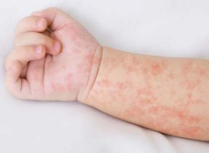 hand-of-newborn-baby-with-measles-rash-on-white