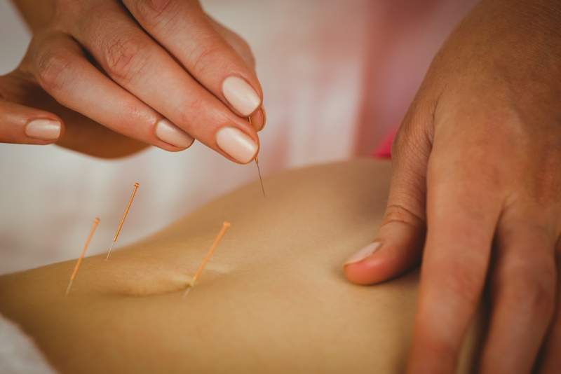 young-woman-getting-acupuncture-treatment