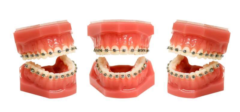 teeth-model-with-wired-dental-braces