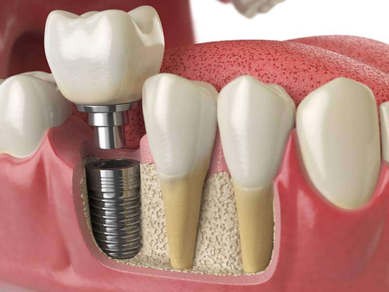 anatomy-of-healthy-teeth-and-tooth-dental-implant